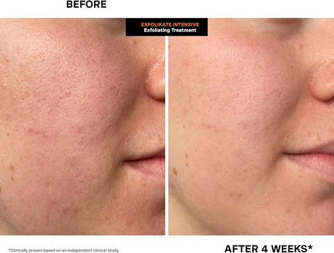 trattamento viso Kate Somerville ExfoliKat Intensive Exfoliating Treatment